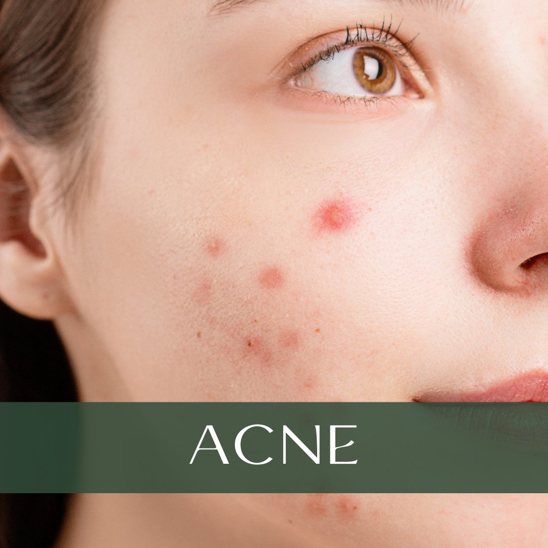 Woman with acne on her face