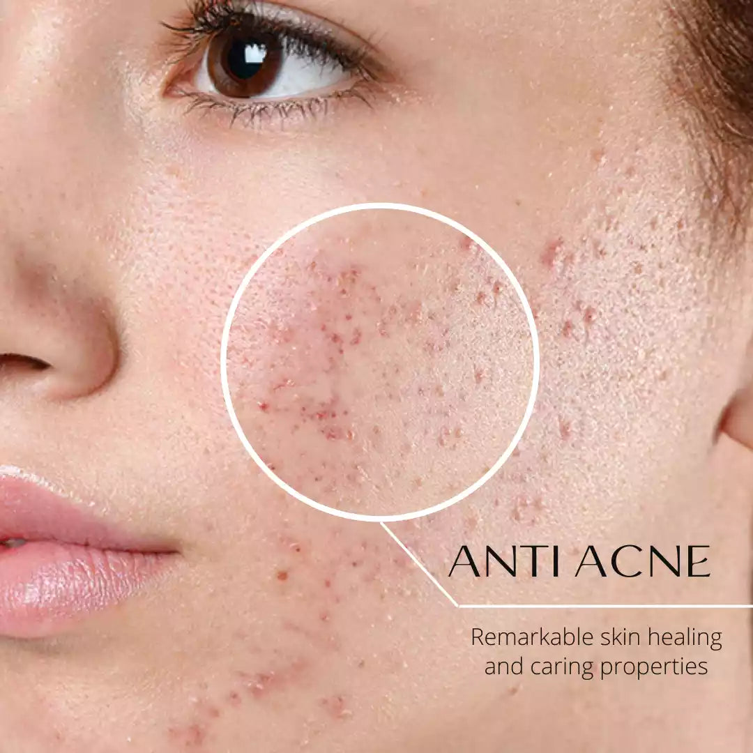 Women with acne and oily skin