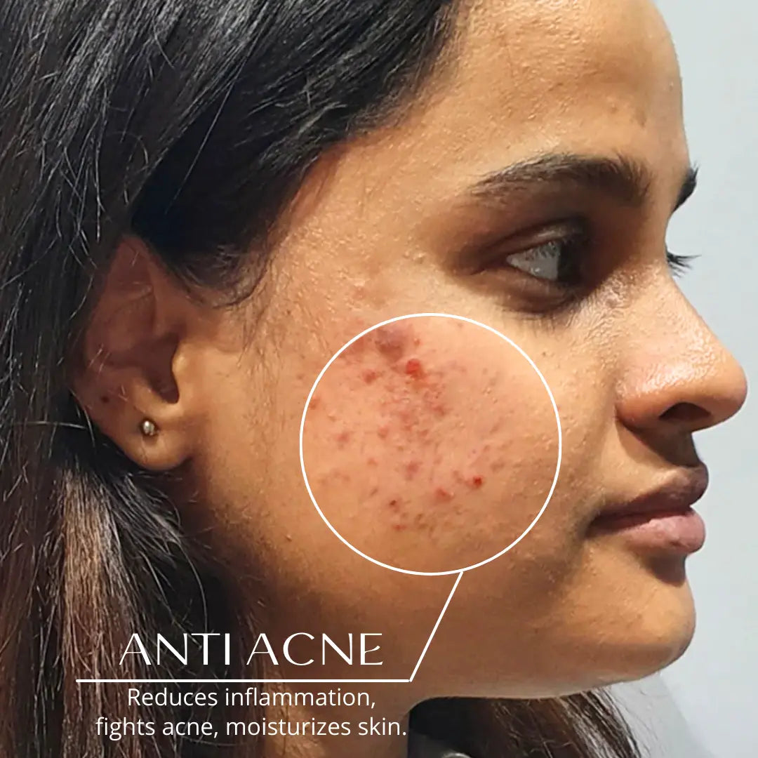 Women with acne and uneven skin tone