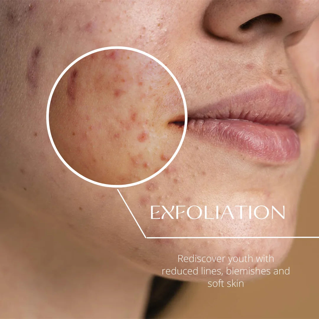 Woman with acne scarring and fine lines