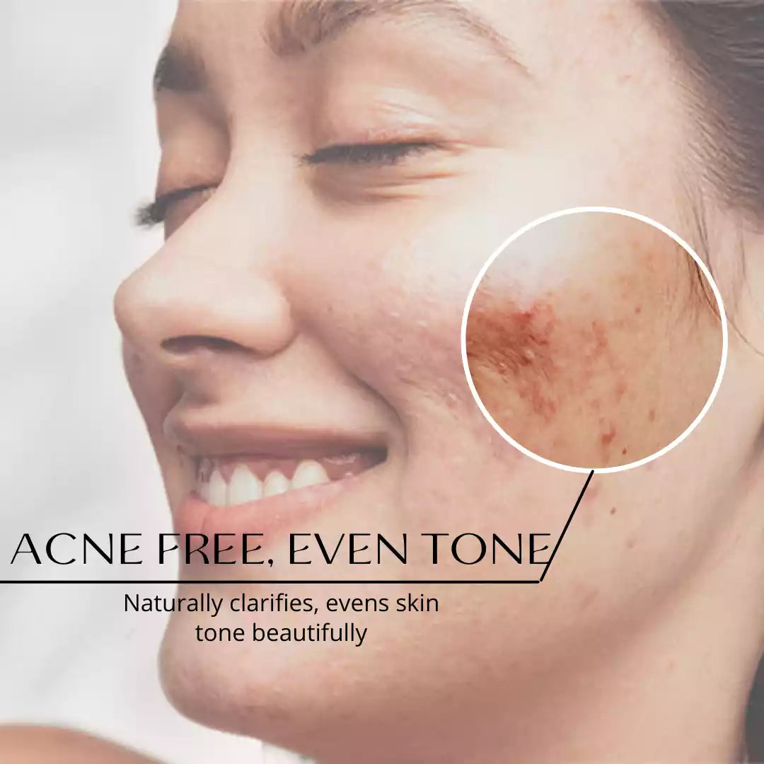 Women with acne and uneven skin tone