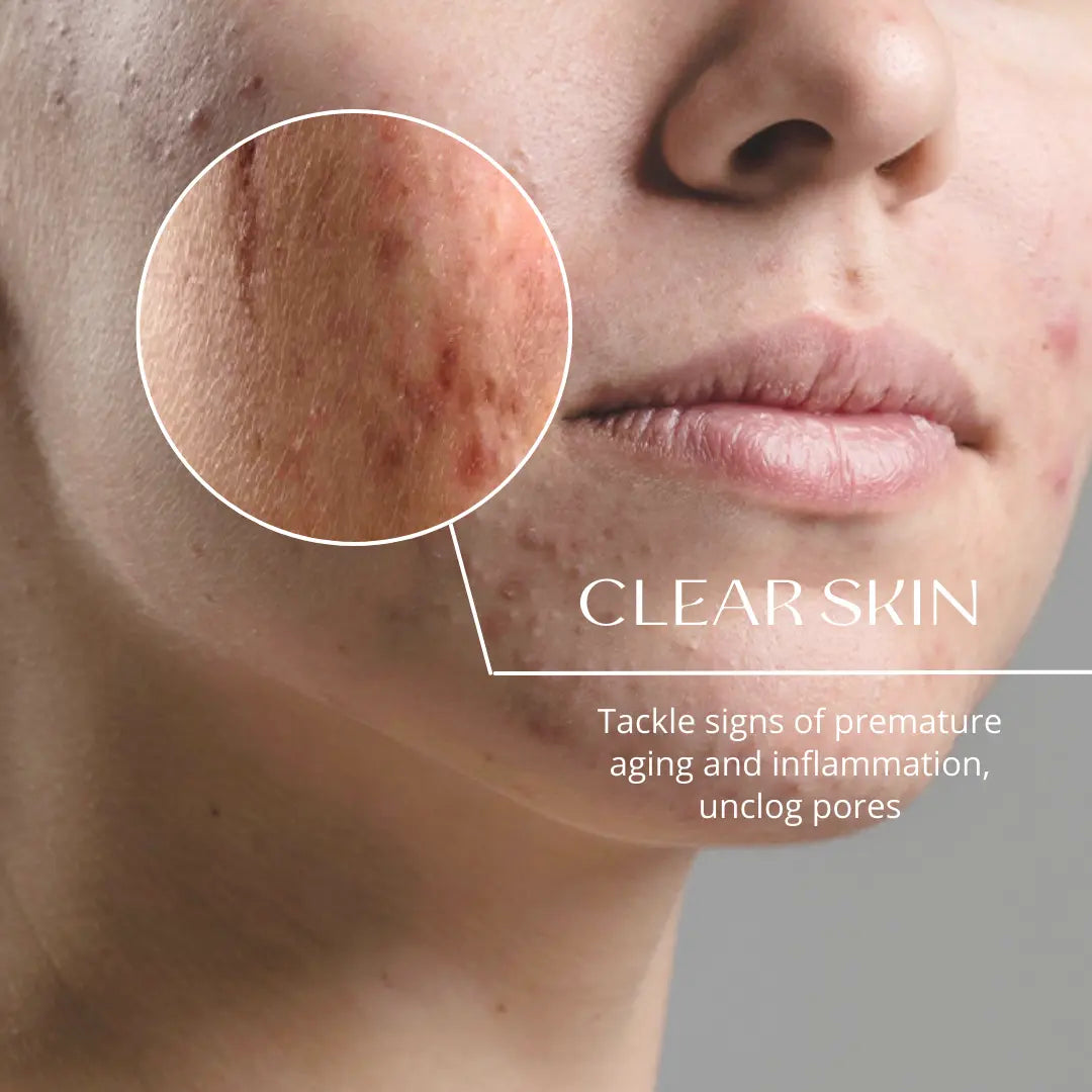 Woman with acne scar and inflamed skin 